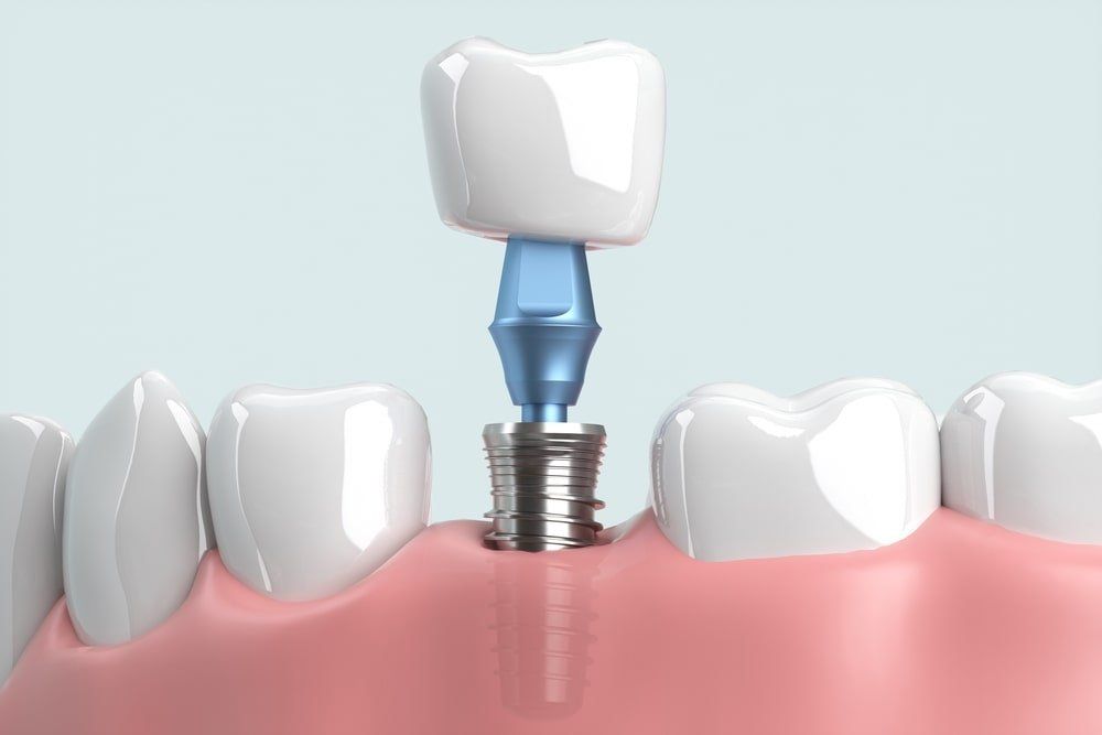 Une illustration 3D représentant des implants dentaires