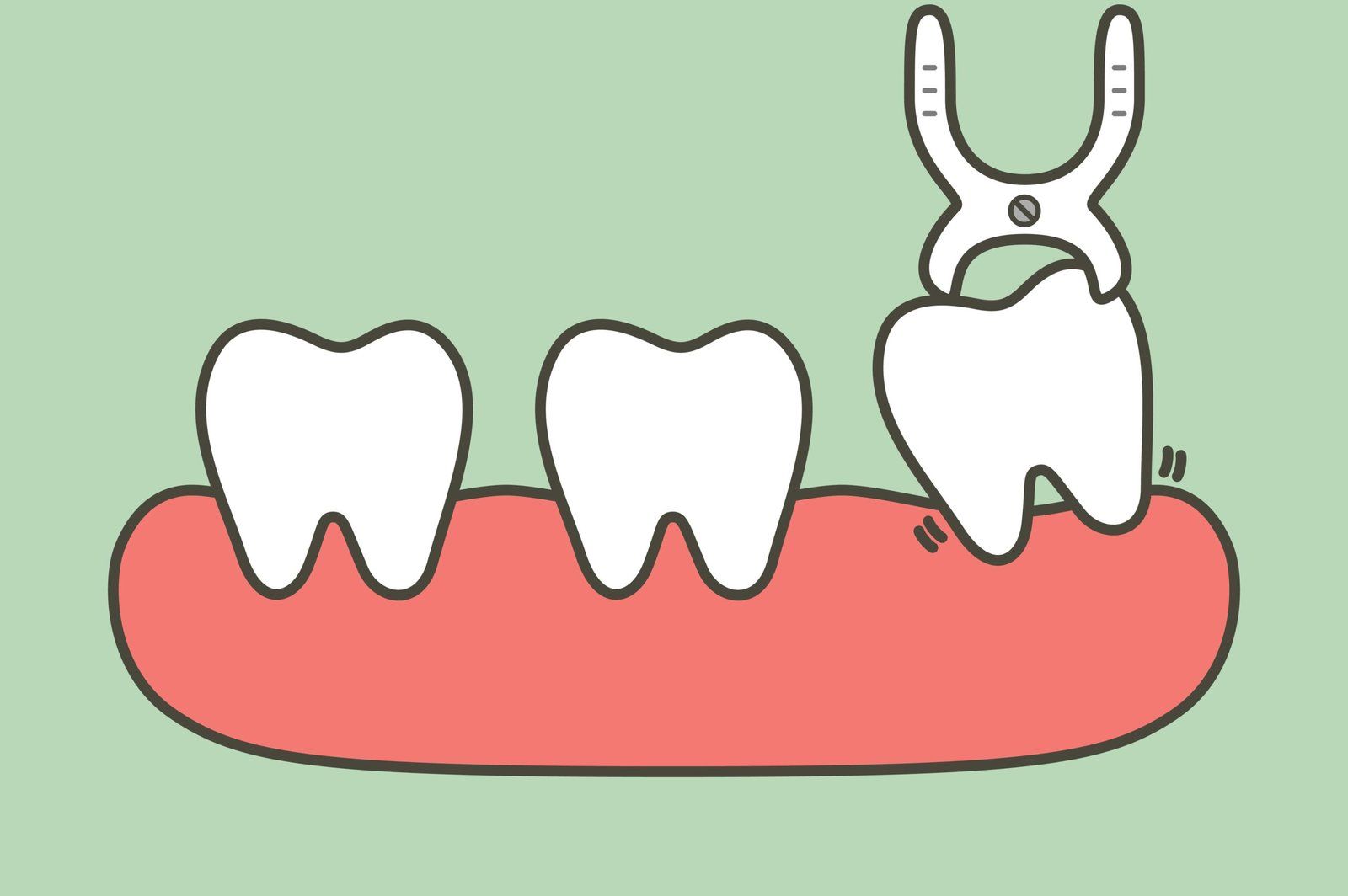 illustration d'une extraction dentaire