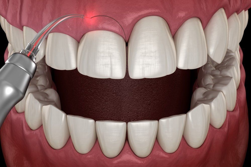 Le traitement du sourire gingival en dentisterie