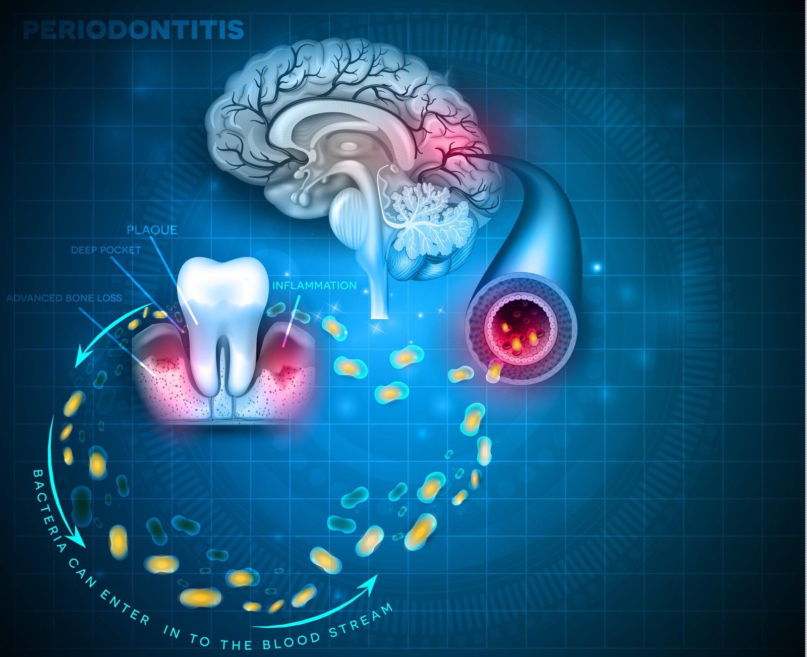 Une illustration des effets des maladies des gencives sur le cerveau et le développement des maladies neurodégénératives