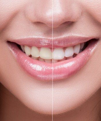 MÉTAMORPHOSE DU SOURIRE
