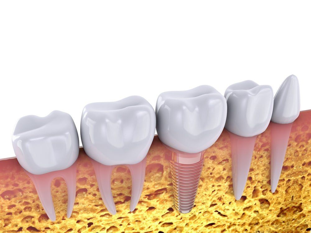 L'implantologie dentaire où les implants sont insérés dans l'os de la mâchoire