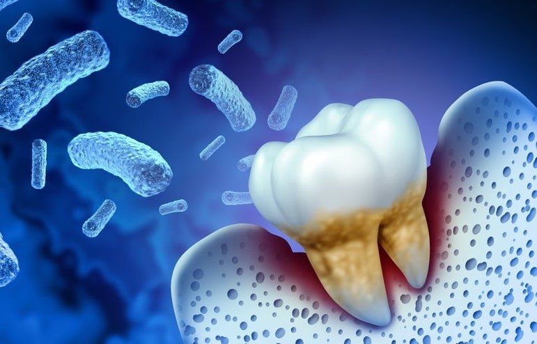 La parodontite est liée à une importante prolifération des bactéries nocives