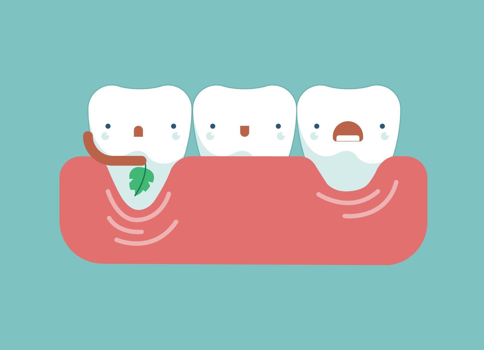 Illustration ludique de la récession gingivale
