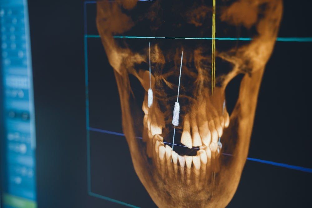 Les images obtenues avec le scan 3D qui guident la chirurgie en implantologie
