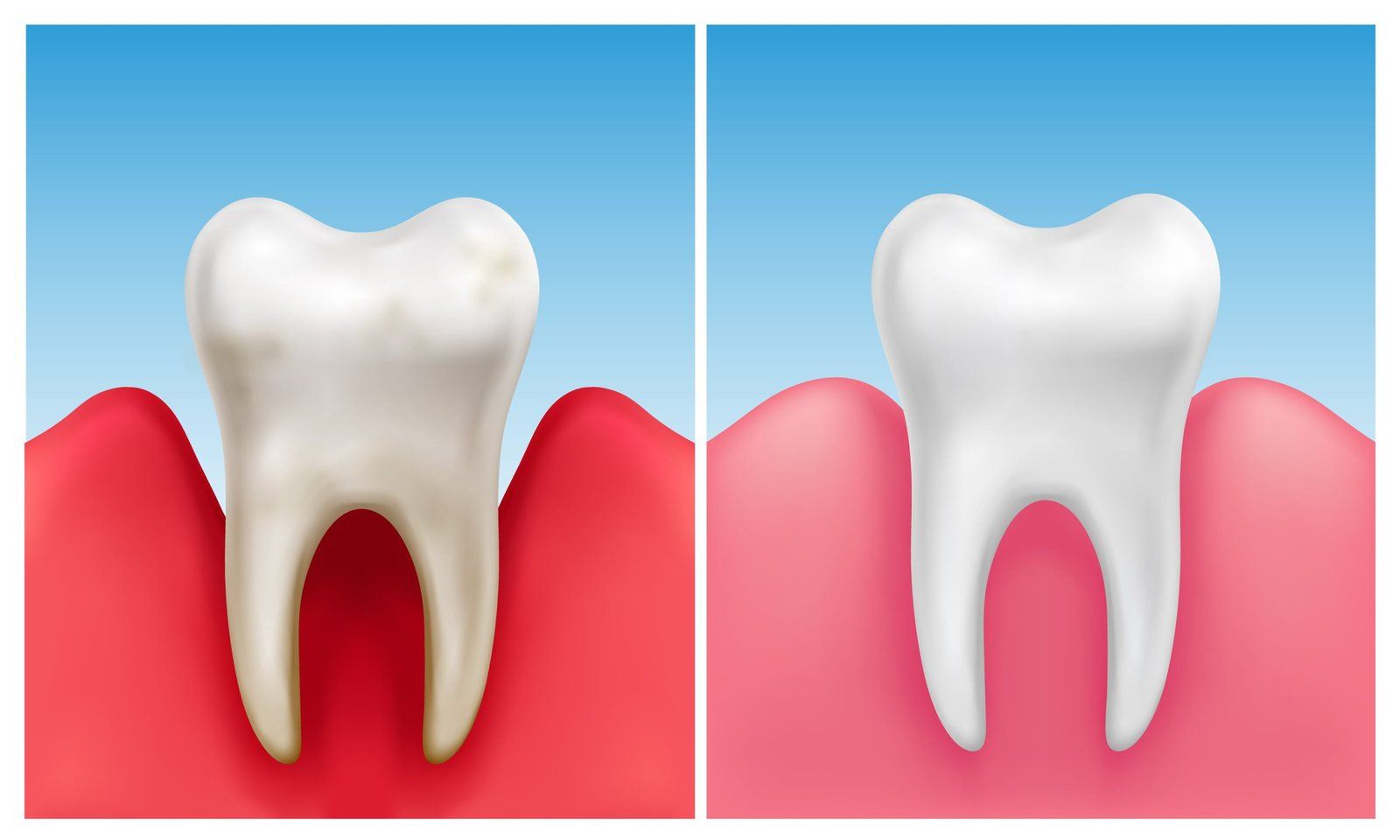 illustration d'une gencive saine vs une gencive malade